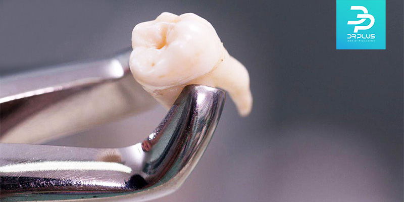 از مراقبت بعد از کشیدن دندان چه اطلاعاتی دارید ؟