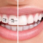 بایدها و نبایدهایی که باید برای مراقبت از ارتودنسی دندان بدانیم