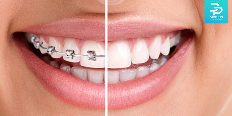 بایدها و نبایدهایی که باید برای مراقبت از ارتودنسی دندان بدانیم