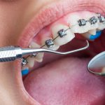 مراقبت از ارتودنسی دندان شامل چه مواردی است