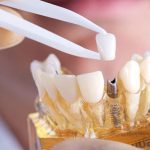 مراقبت بعد از ایمپلنت دندان چه مواردی را شامل میشود