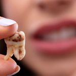مراقبت بعد از عصب کشی دندان شامل چه نکاتی است