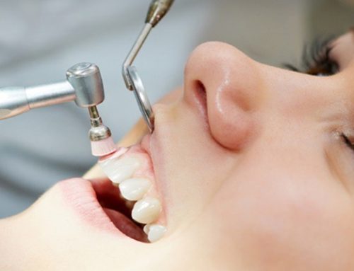 مراقبت بعد از جرمگیری دندان