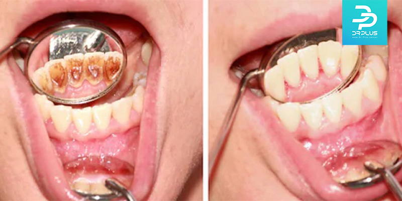 نکات مهم در مراقبت بعد از جرمگیری دندان