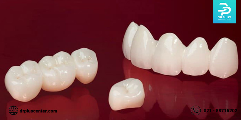 بایدها و نبایدهایی که باید در مورد مراقبت از دندان روکش شده بدانید