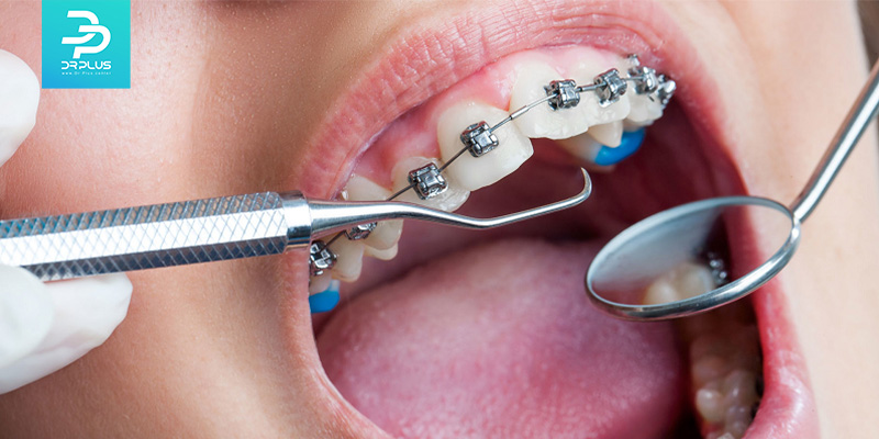 مراقبت از ارتودنسی دندان شامل چه مواردی است