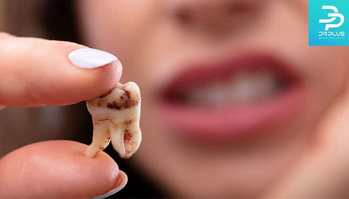 مراقبت بعد از عصب کشی دندان شامل چه نکاتی است